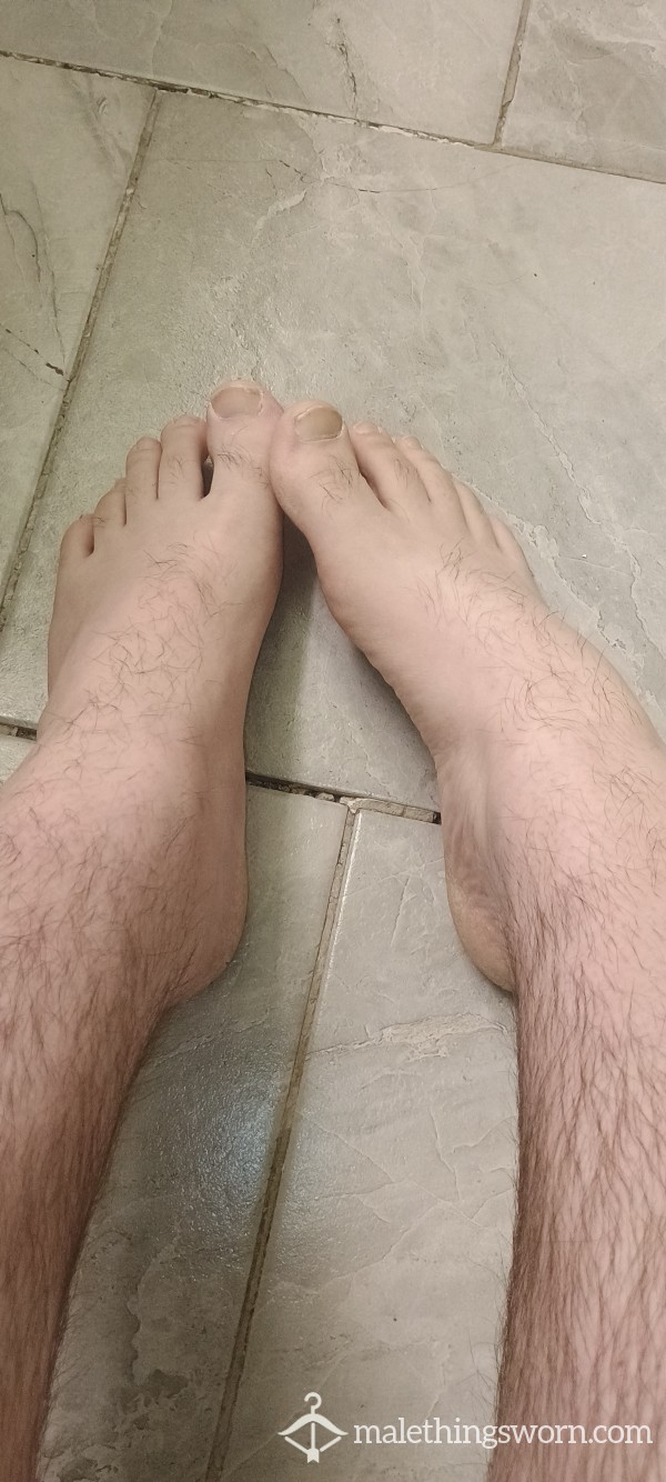 Cracked Heels Feet Pics