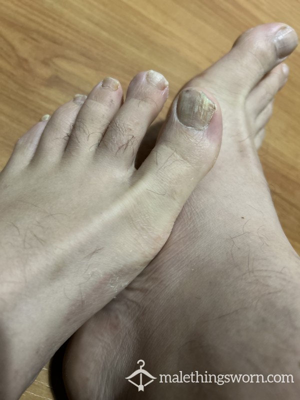 Feet Of A Hardworking Lad - Wrinkles, Fungi, Toes, Dead Skin