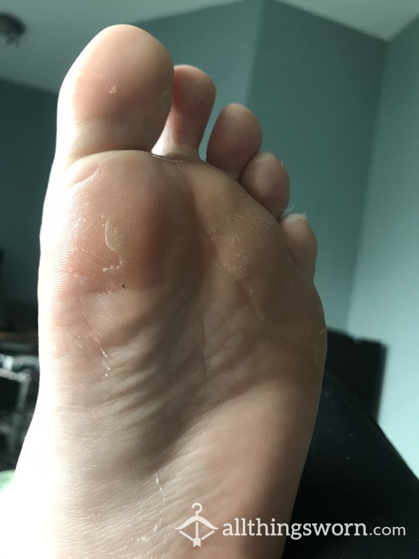 Foot P**l, Flaky Skin- Fresh From A Foot P**l