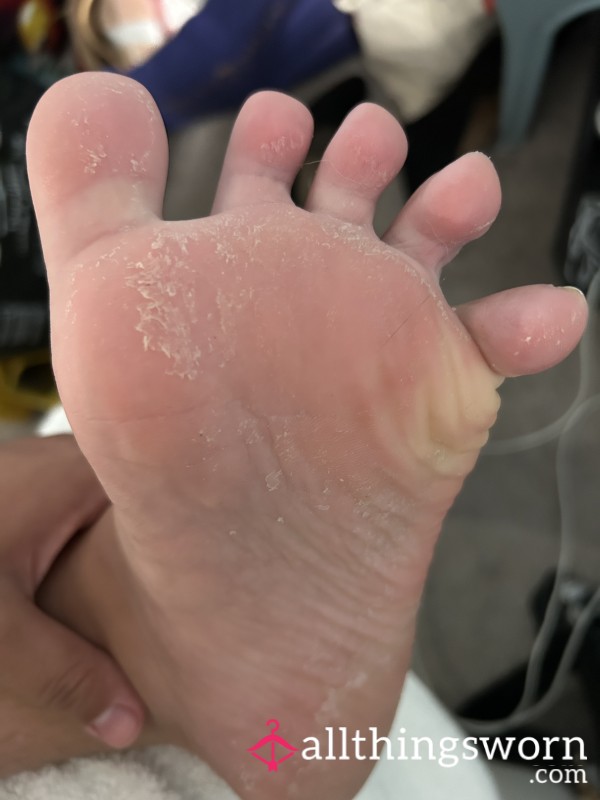 Nasty Skin-p**ling Feet