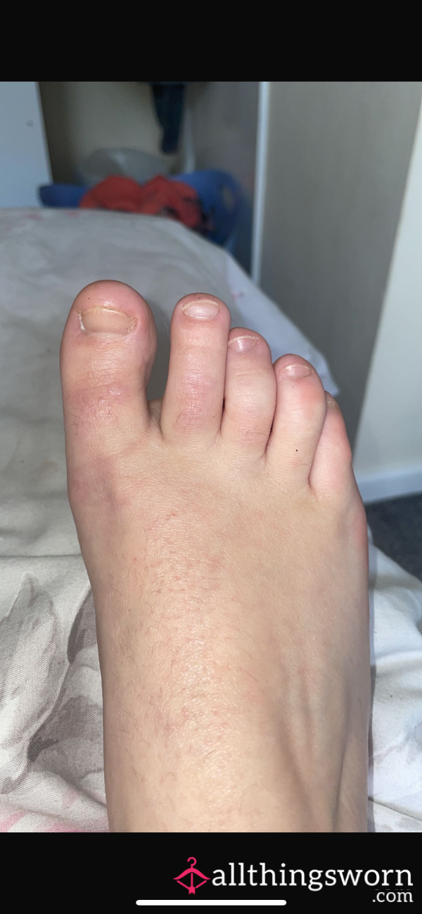 Ugly Feet Pics