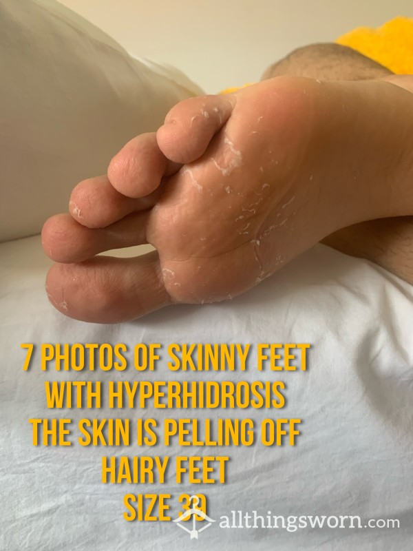 Ugly Feet With Hyperhidrosis | P**ling Off | Size 9| Hairy Feet